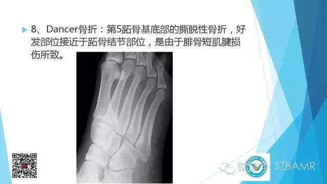 【PPT】(40种)特殊骨折命名方法及图示