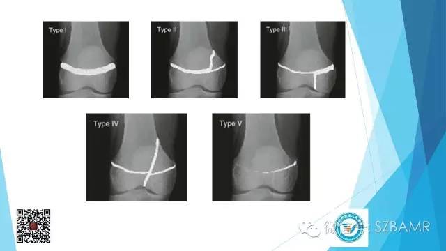 【PPT】(40种)特殊骨折命名方法及图示