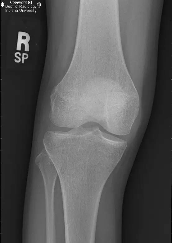 【PPT】骨缺血性坏死及骨梗死1例