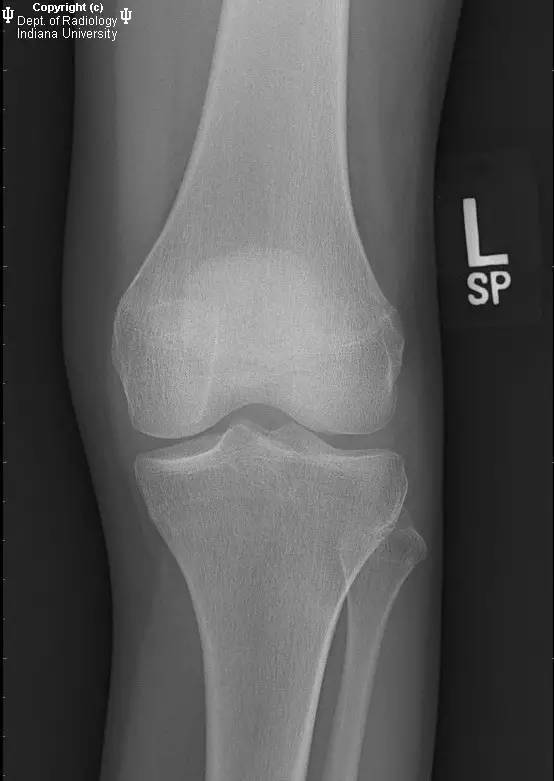 【PPT】骨缺血性坏死及骨梗死1例