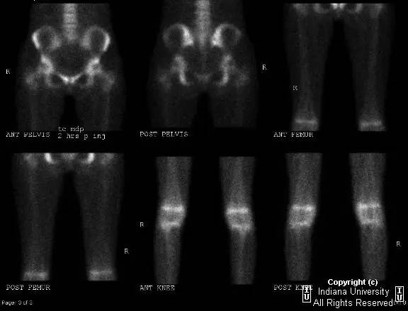 【PPT】骨缺血性坏死及骨梗死1例