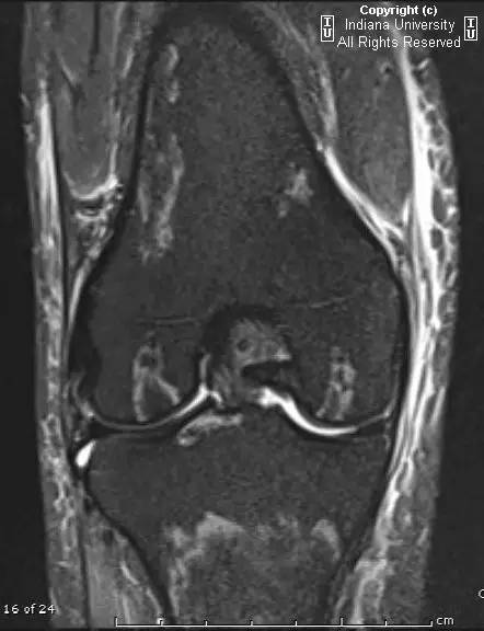 【PPT】骨缺血性坏死及骨梗死1例