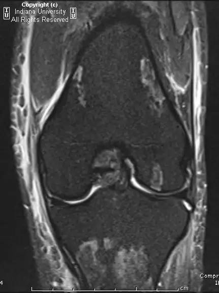 【PPT】骨缺血性坏死及骨梗死1例