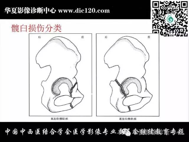 【PPT】髋关节常见疾病影像学诊断
