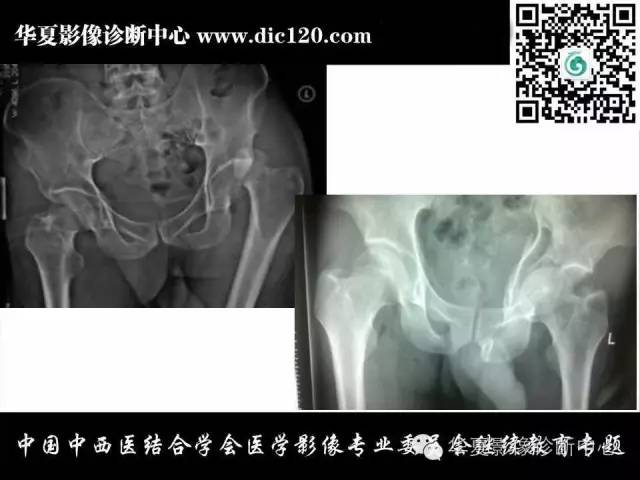 【PPT】髋关节常见疾病影像学诊断