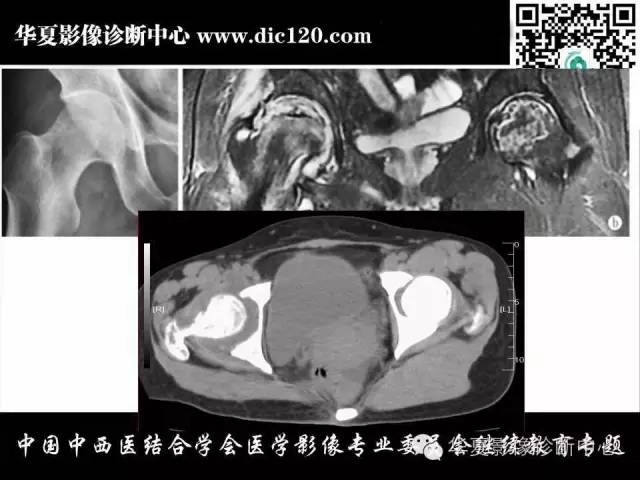 【PPT】髋关节常见疾病影像学诊断