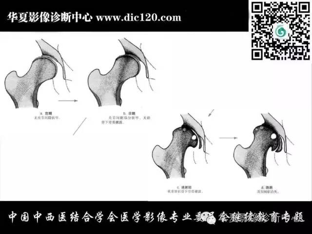 【PPT】髋关节常见疾病影像学诊断