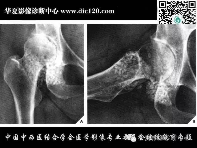 【PPT】髋关节常见疾病影像学诊断