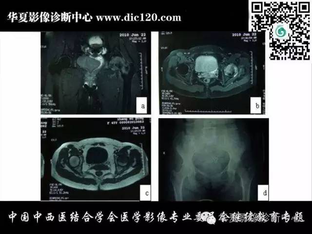 【PPT】髋关节常见疾病影像学诊断
