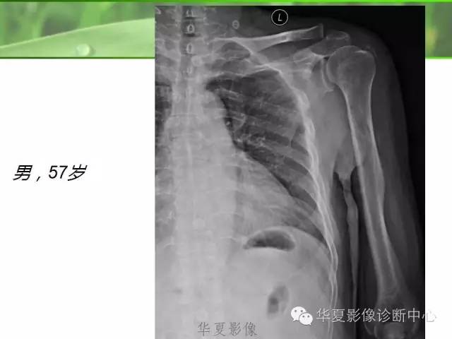 X线片怎么看肩周炎