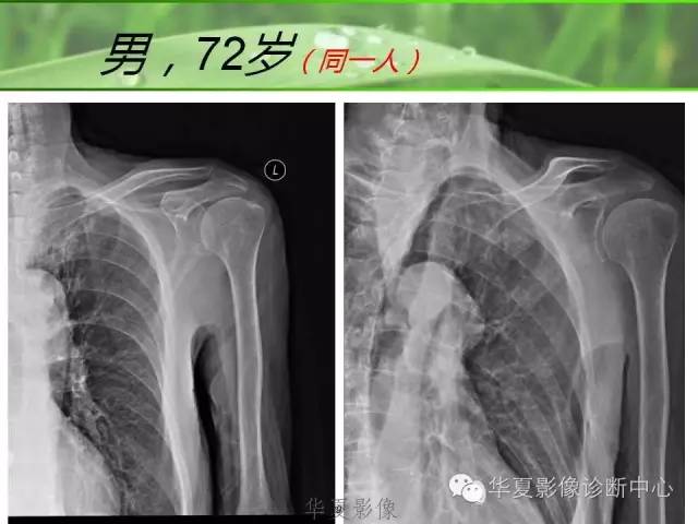 X线片怎么看肩周炎