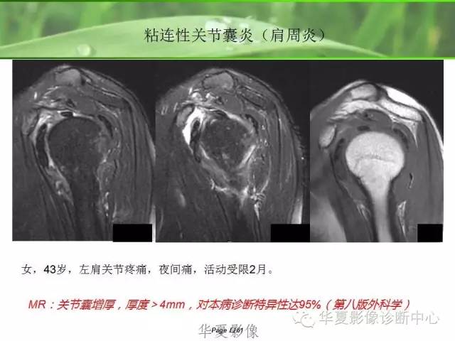 X线片怎么看肩周炎