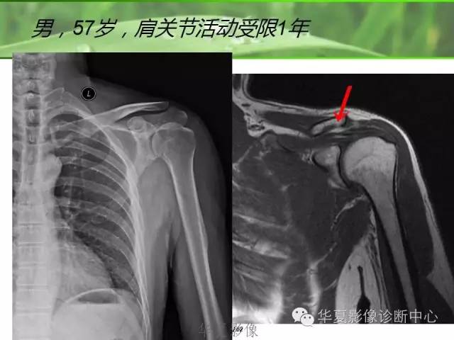 X线片怎么看肩周炎