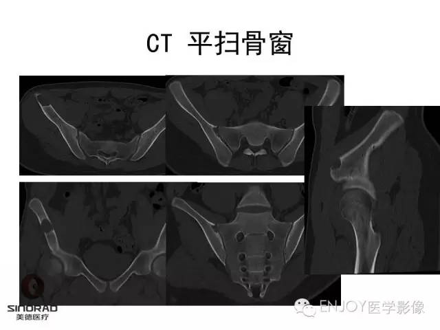 【病例】右侧髂骨血管内皮瘤1例CT及MR病例读片
