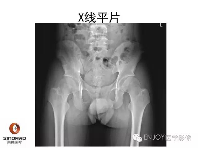 【病例】右侧髂骨血管内皮瘤1例CT及MR病例读片