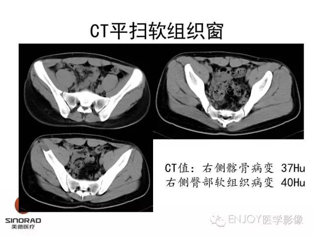 【病例】右侧髂骨血管内皮瘤1例CT及MR病例读片