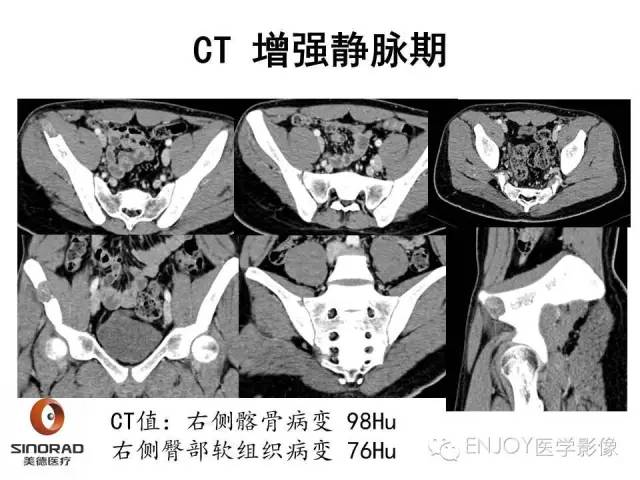【病例】右侧髂骨血管内皮瘤1例CT及MR病例读片