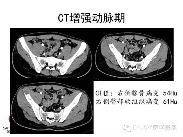 【病例】右侧髂骨血管内皮瘤1例CT及MR病例读片