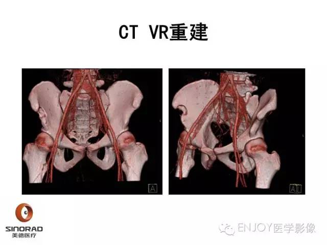 【病例】右侧髂骨血管内皮瘤1例CT及MR病例读片