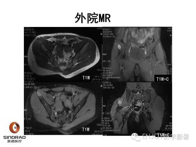 【病例】右侧髂骨血管内皮瘤1例CT及MR病例读片