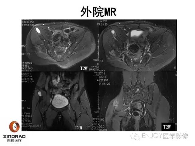 【病例】右侧髂骨血管内皮瘤1例CT及MR病例读片