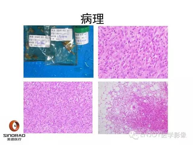 【病例】右侧髂骨血管内皮瘤1例CT及MR病例读片