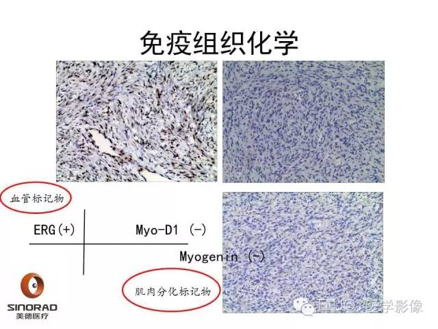 【病例】右侧髂骨血管内皮瘤1例CT及MR病例读片
