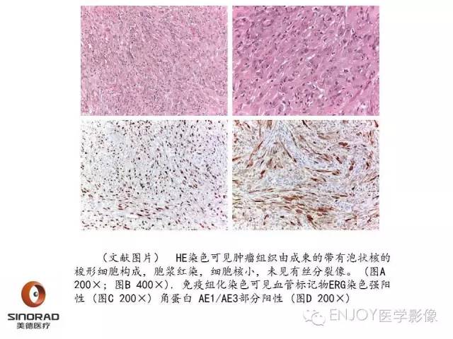 【病例】右侧髂骨血管内皮瘤1例CT及MR病例读片
