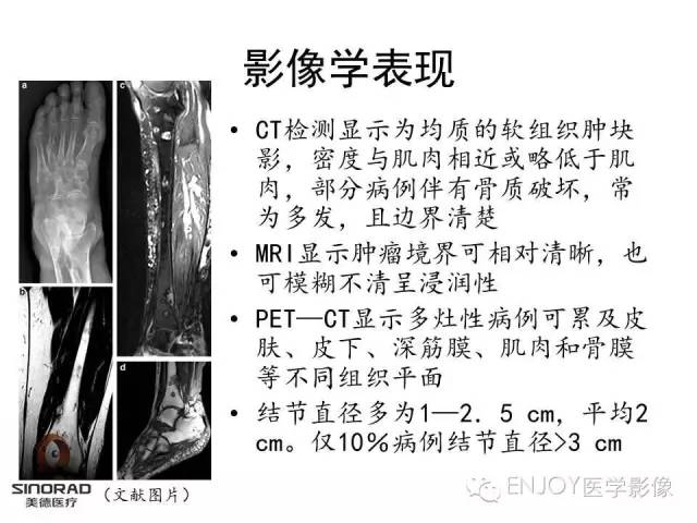 【病例】右侧髂骨血管内皮瘤1例CT及MR病例读片