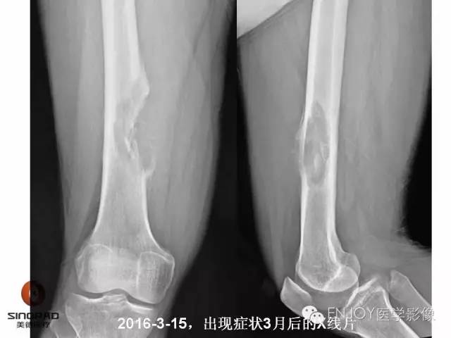 【病例】右侧股骨多形性肉瘤1例X线及MR影像表现