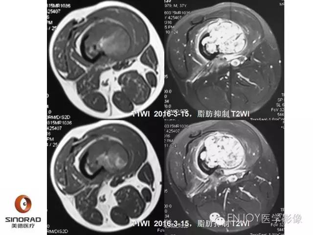【病例】右侧股骨多形性肉瘤1例X线及MR影像表现
