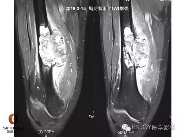 【病例】右侧股骨多形性肉瘤1例X线及MR影像表现