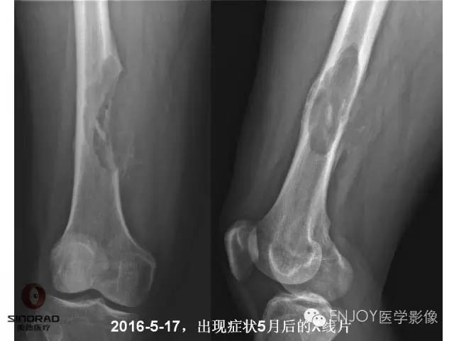 【病例】右侧股骨多形性肉瘤1例X线及MR影像表现