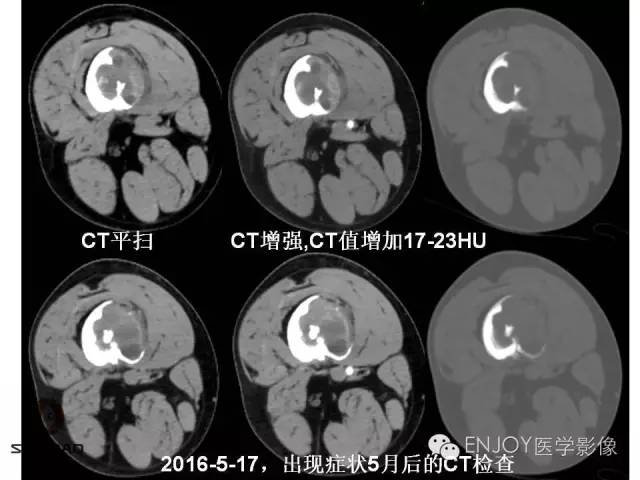 【病例】右侧股骨多形性肉瘤1例X线及MR影像表现