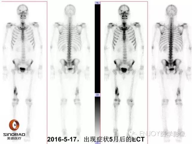 【病例】右侧股骨多形性肉瘤1例X线及MR影像表现