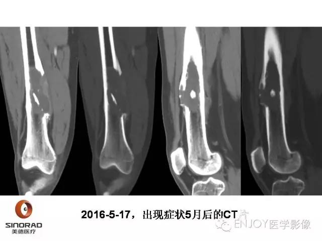 【病例】右侧股骨多形性肉瘤1例X线及MR影像表现