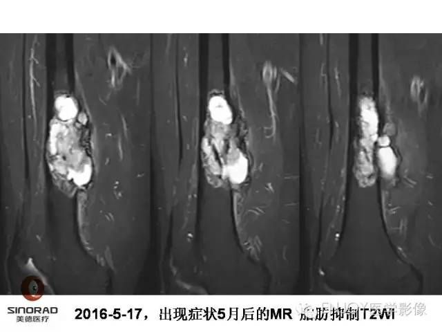 【病例】右侧股骨多形性肉瘤1例X线及MR影像表现