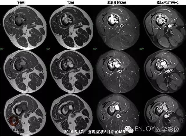 【病例】右侧股骨多形性肉瘤1例X线及MR影像表现