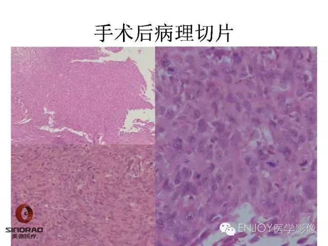 【病例】右侧股骨多形性肉瘤1例X线及MR影像表现