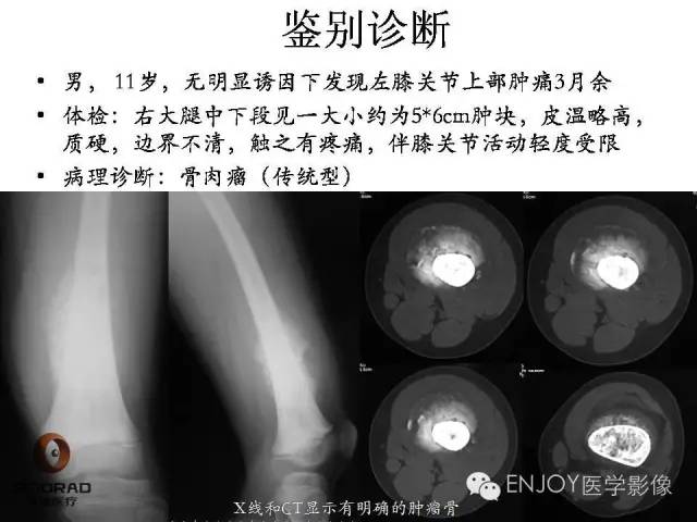 【病例】右侧股骨多形性肉瘤1例X线及MR影像表现