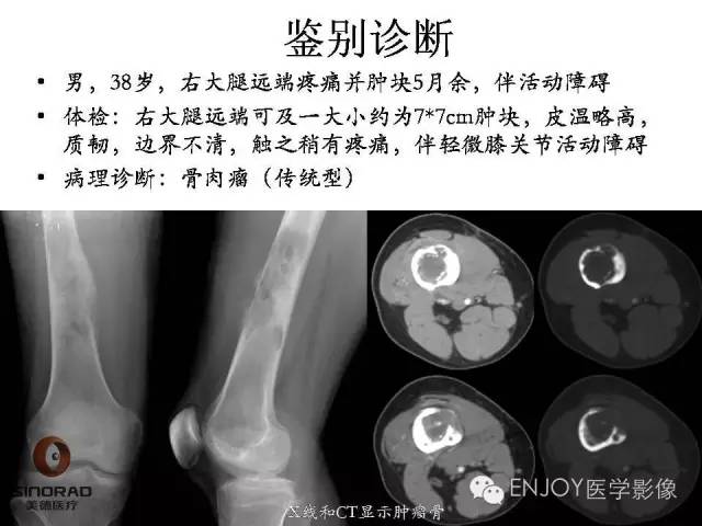 【病例】右侧股骨多形性肉瘤1例X线及MR影像表现