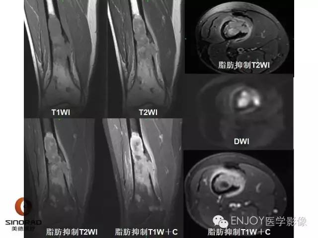 【病例】右侧股骨多形性肉瘤1例X线及MR影像表现