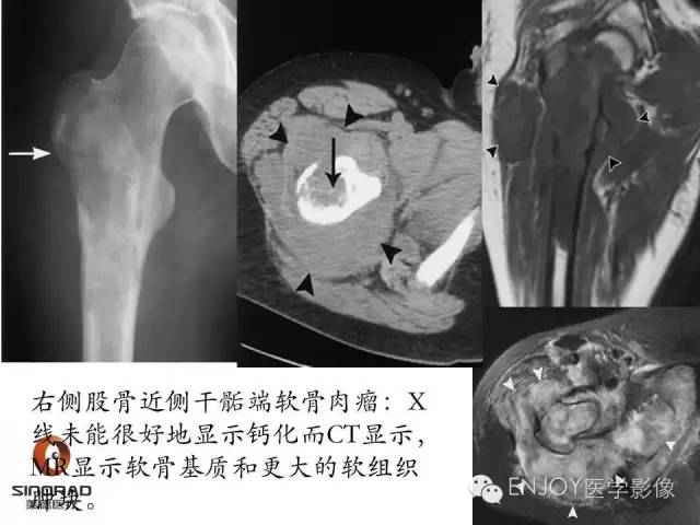 【病例】右侧股骨多形性肉瘤1例X线及MR影像表现