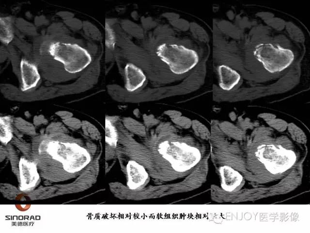 【病例】右侧股骨多形性肉瘤1例X线及MR影像表现