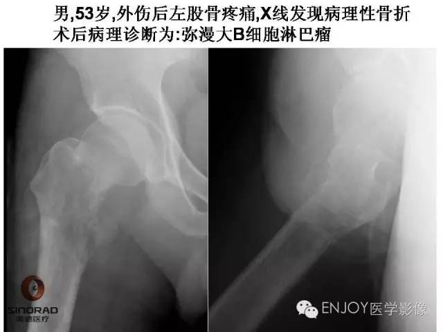 【病例】右侧股骨多形性肉瘤1例X线及MR影像表现