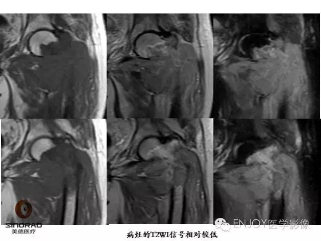 【病例】右侧股骨多形性肉瘤1例X线及MR影像表现