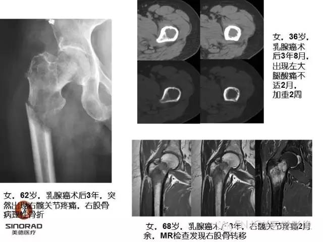【病例】右侧股骨多形性肉瘤1例X线及MR影像表现