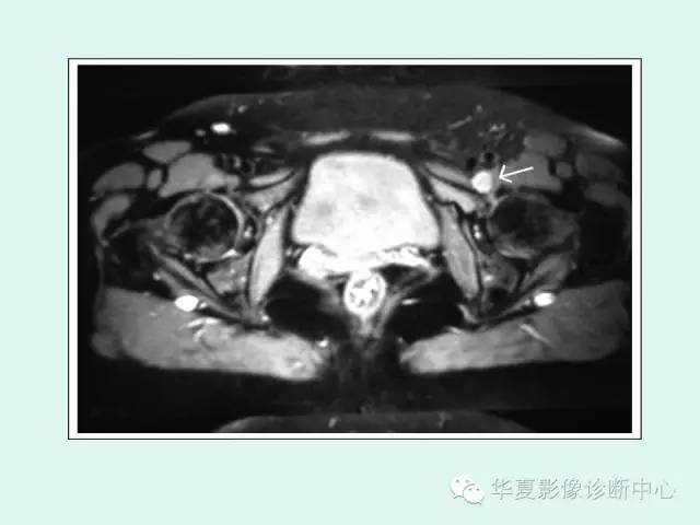 【PPT】大转子周围滑囊炎