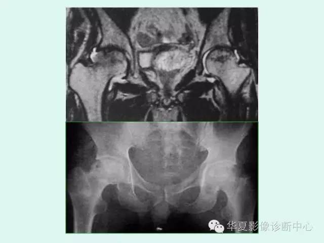 【PPT】股骨头缺血性坏死