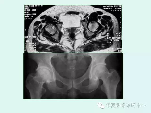 【PPT】股骨头缺血性坏死